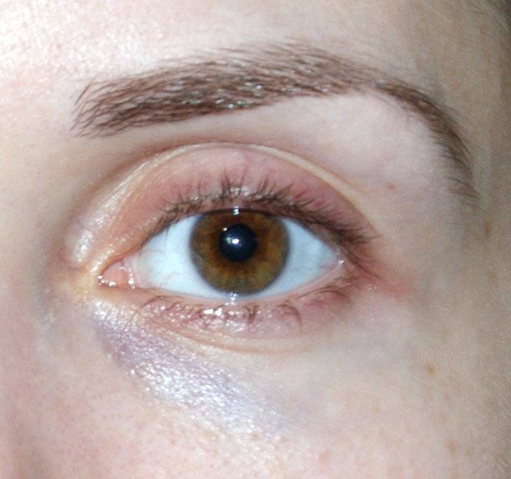 Синяки в уголках глаз у переносицы - причины появления, как убрать