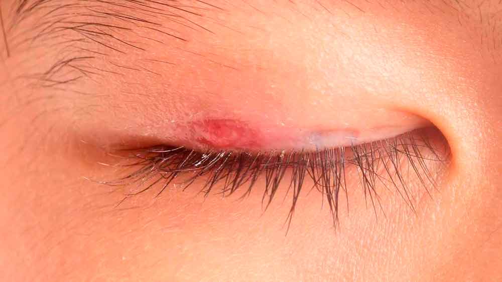 Блефарит век: симптомы и лечение глаз у взрослых и детей