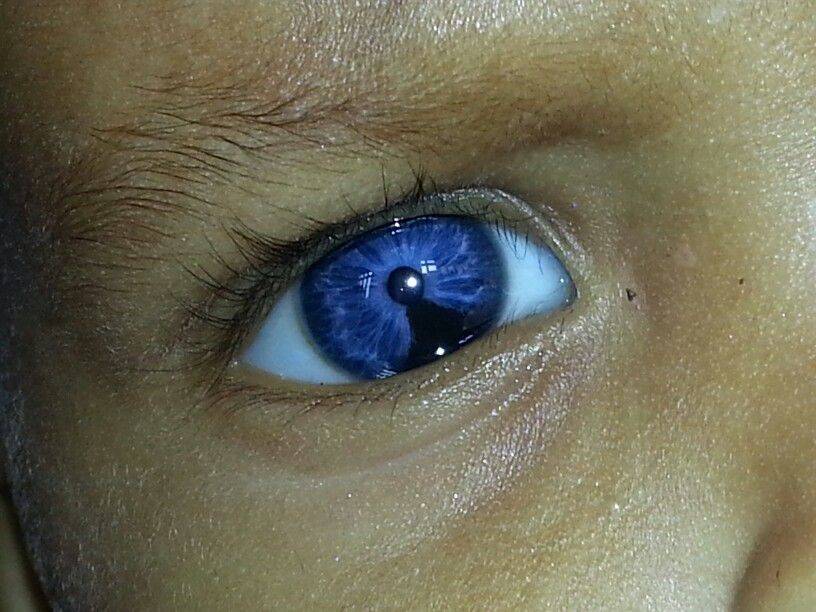 Синдром кошачьего глаза: что это такое, симптомы (фото), лечение, прогноз