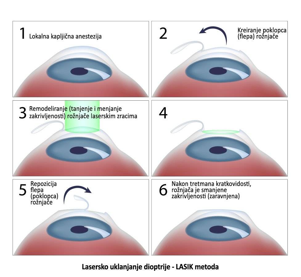 Ограничения после лазерной коррекции зрения