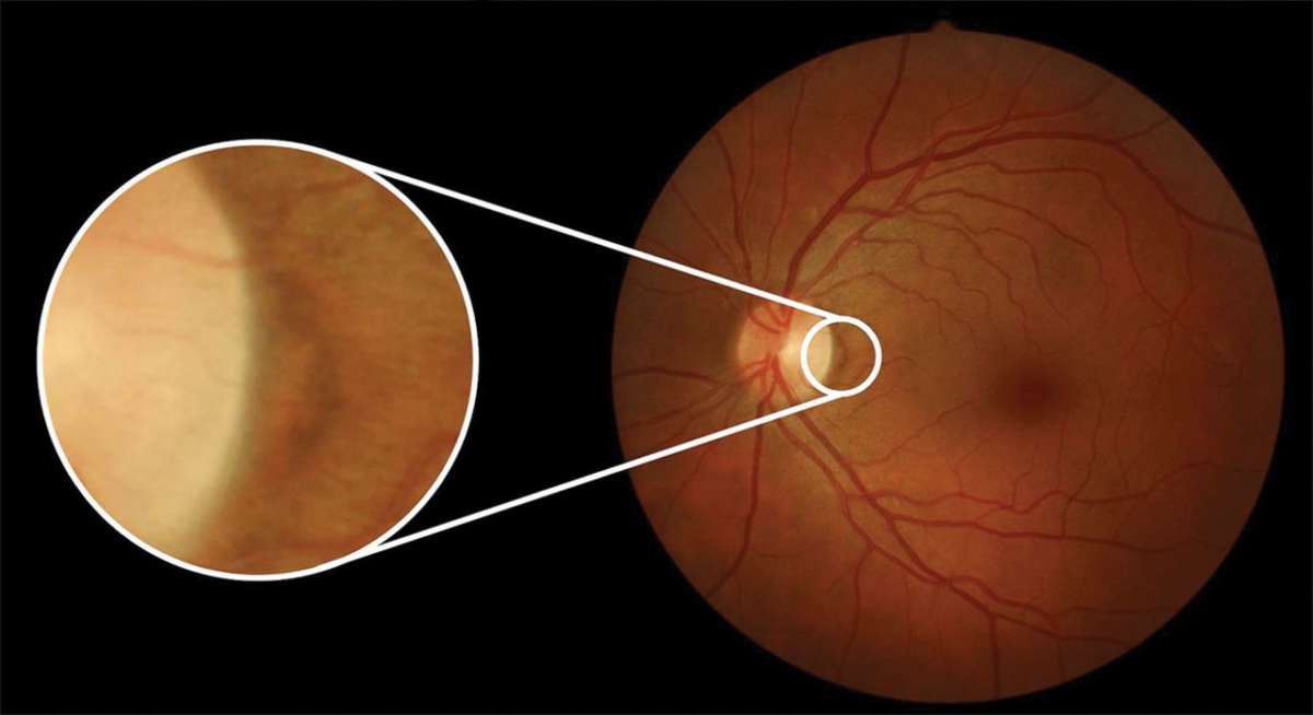 Сетчатка глаза - патология сетчатки: симптомы, диагностика и лечение заболеваний сетчатки - moscoweyes.ru - сайт офтальмологического центра "мгк-диагностик"