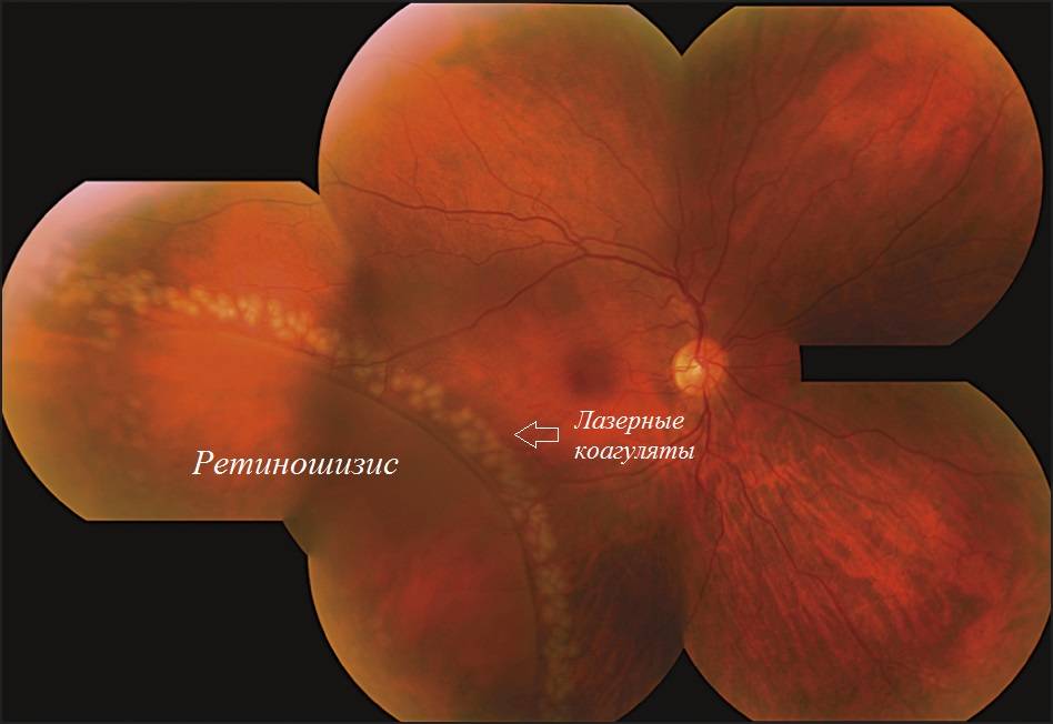 Ретиношизис или расслоение сетчатки глаза - что это такое, причины, симптомы и лечение патологии, прогноз сохранения зрения