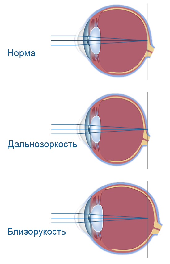 Изображение на сетчатке глаза появляется. Зрение близорукость и дальнозоркость. Глаз при близорукости и дальнозоркости. Дальнозоркость и близорукость строение глаза. Нормальное зрение близорукость дальнозоркость схема.
