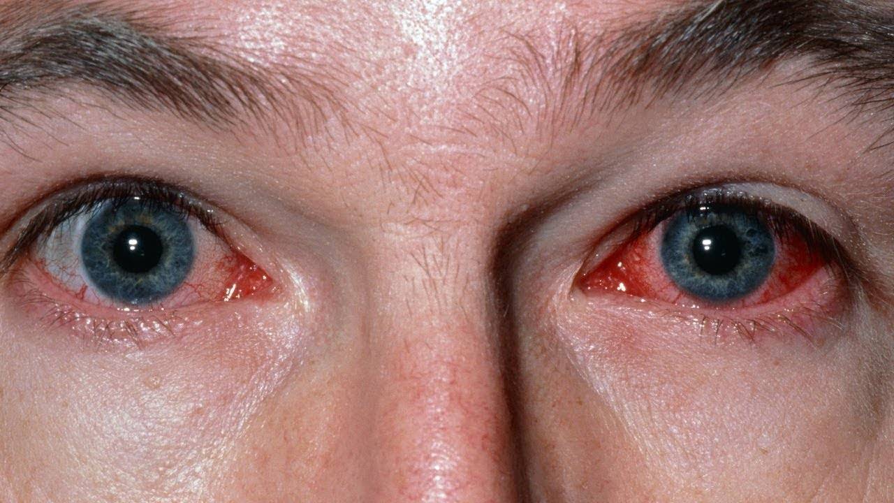 Воспаление сосудистой оболочки глаза