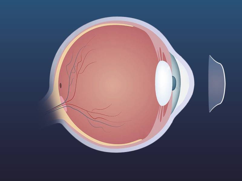 Линзы для ночной коррекции зрения: особые показания, преимущества и недостатки метода