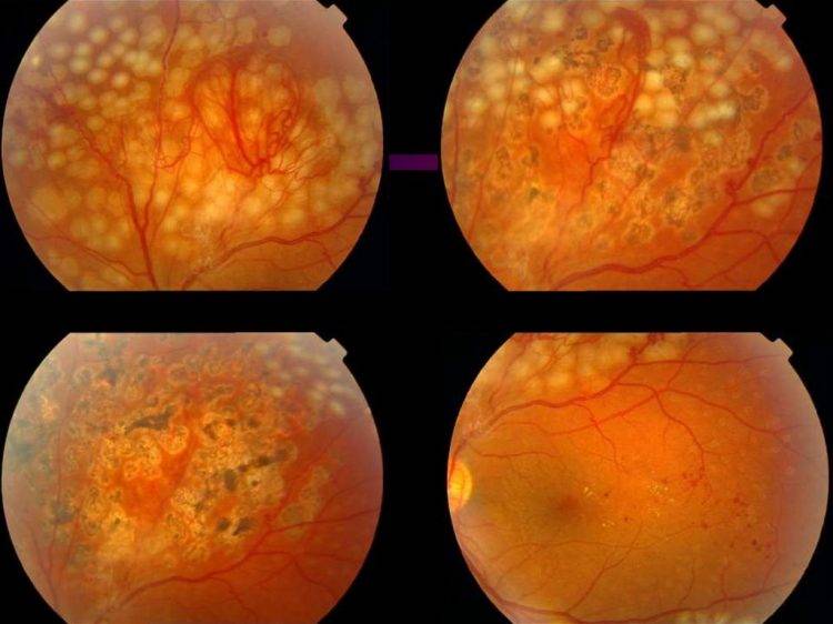 Что такие диабетическая ретинопатия: симптомы, лечение ретинопатии при сахарном диабете, стадии | медицинский портал spacehealth