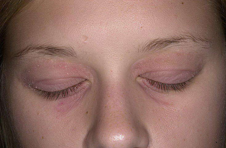 Аллергия на веках: причины, симптомы, лечение, меры профилактики