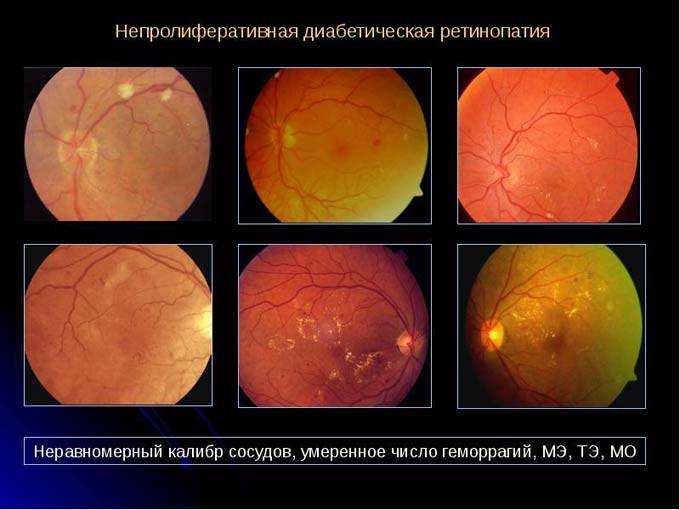 Диабетическая ретинопатия: симптомы, лечение, профилактика
