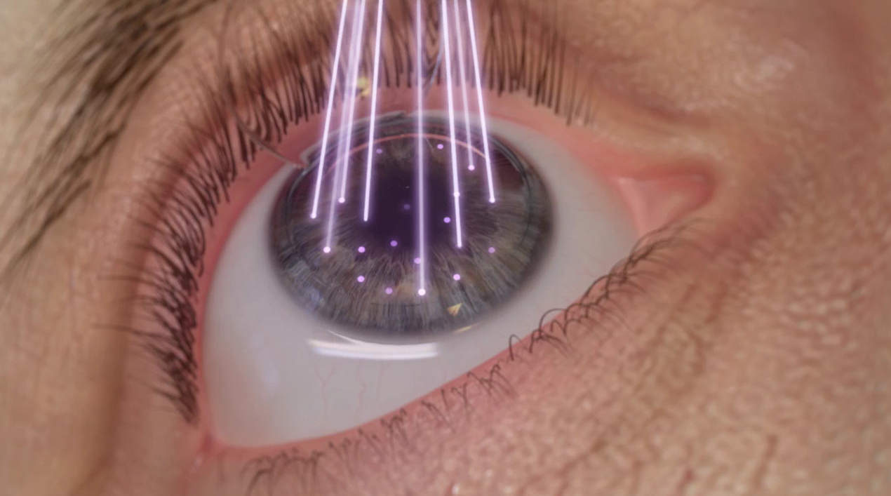 Капли после лазерной коррекции зрения: какие капать для глаз, разные глазные препараты