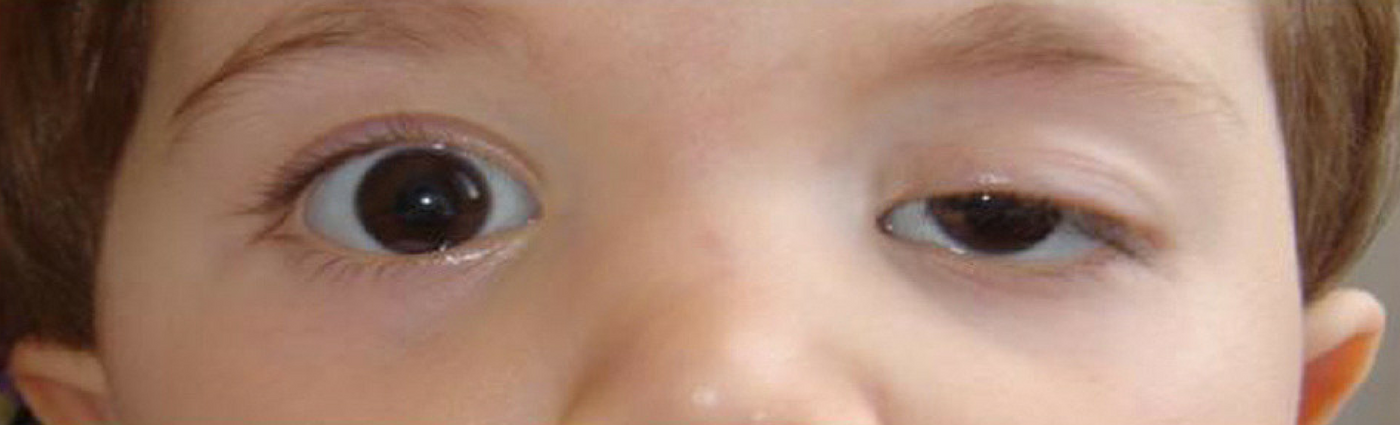 Амблиопия (синдром ленивого глаза) – что это такое, симптомы и лечение