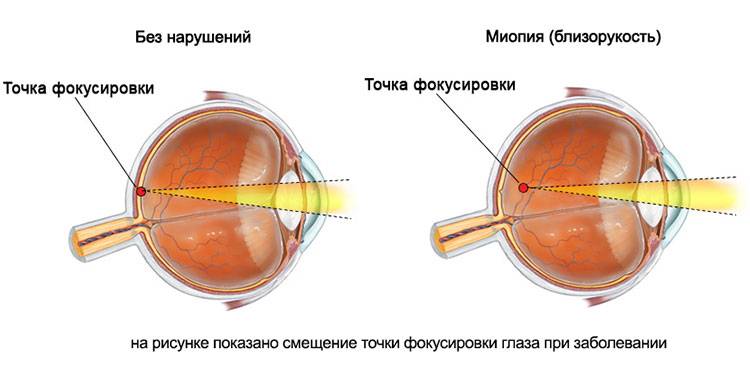 Рефракция глаза: виды, нарушения и определение