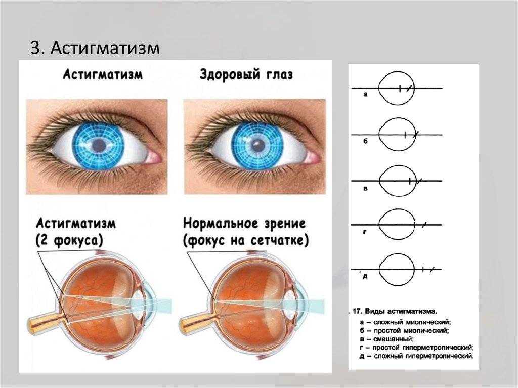 Чем опасен астигматизм глаз: первые признаки и современные методы лечения