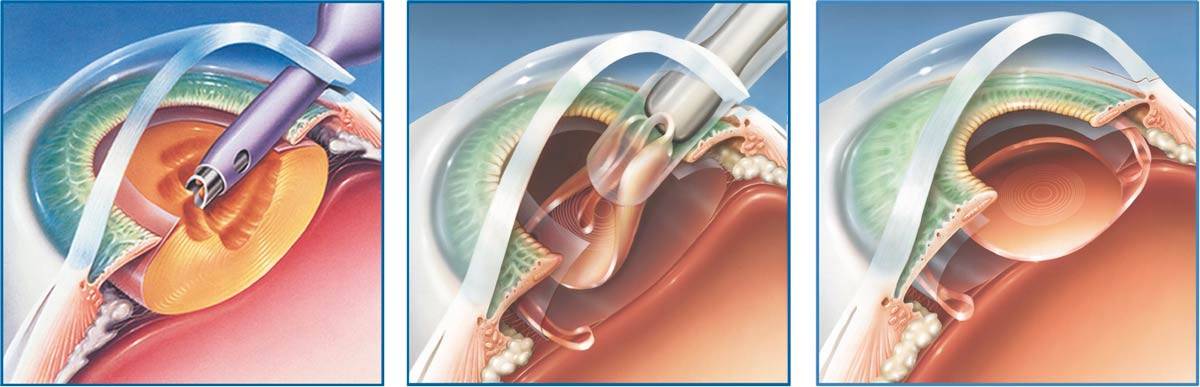 Как делается операция по замене хрусталика глаза — сколько длится и план восстановления