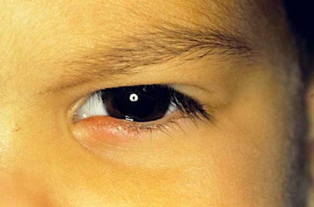 Какие капли и мази гарантируют эффективное лечение ячменя на глазах у детей