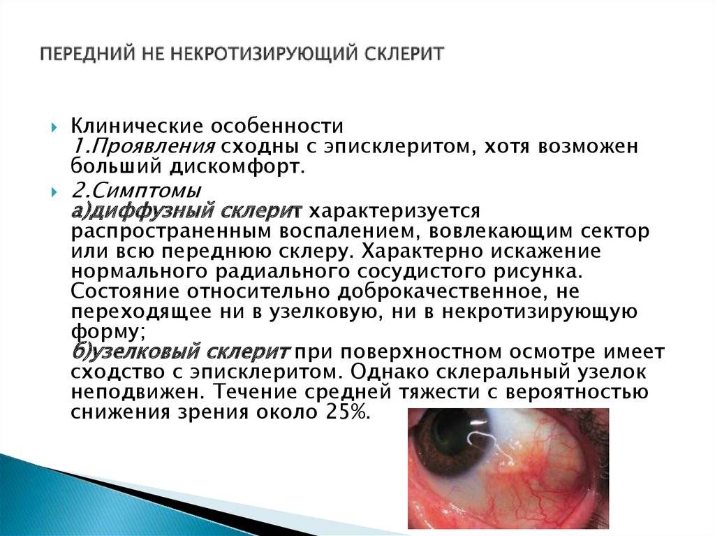 Эписклерит глаза: симптомы, лечение у взрослых и детей