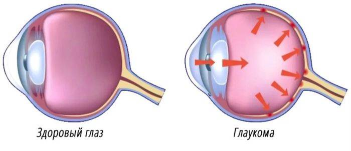 Глазное давление у детей. Здоровый глаз и глаукома. Массажер для глаз при глаукоме. Как выглядит глазное давление. Норма глазного давления при глаукоме.