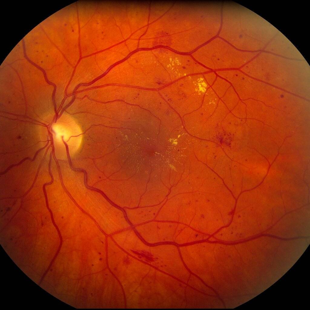Ангиопатия сетчатки обоих глаз: что это такое, симптомы и лечение