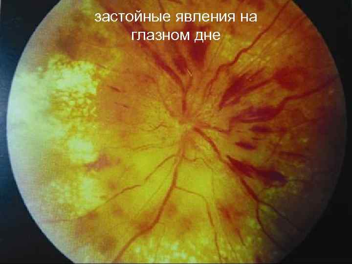 Застойный диск зрительного нерва: лечение, симптомы, причины, стадии