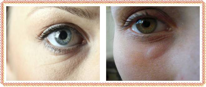 Отеки под глазами по утрам: причины, лечение - "здоровое око"