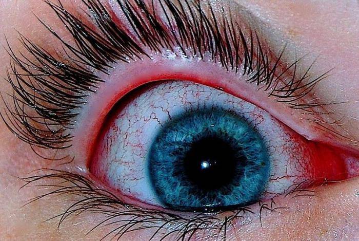 От линз краснеют глаза: что делать при симптоме, причины и лечение