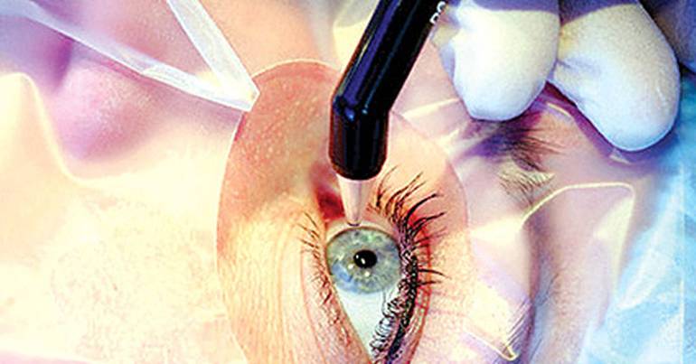 Самые эффективные глазные капли от катаракты