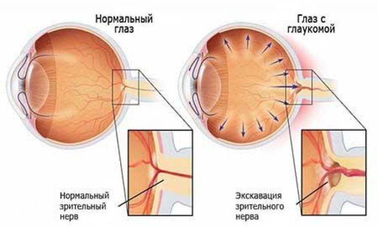 Закрытоугольная глаукома: симптомы, причины - "здоровое око"