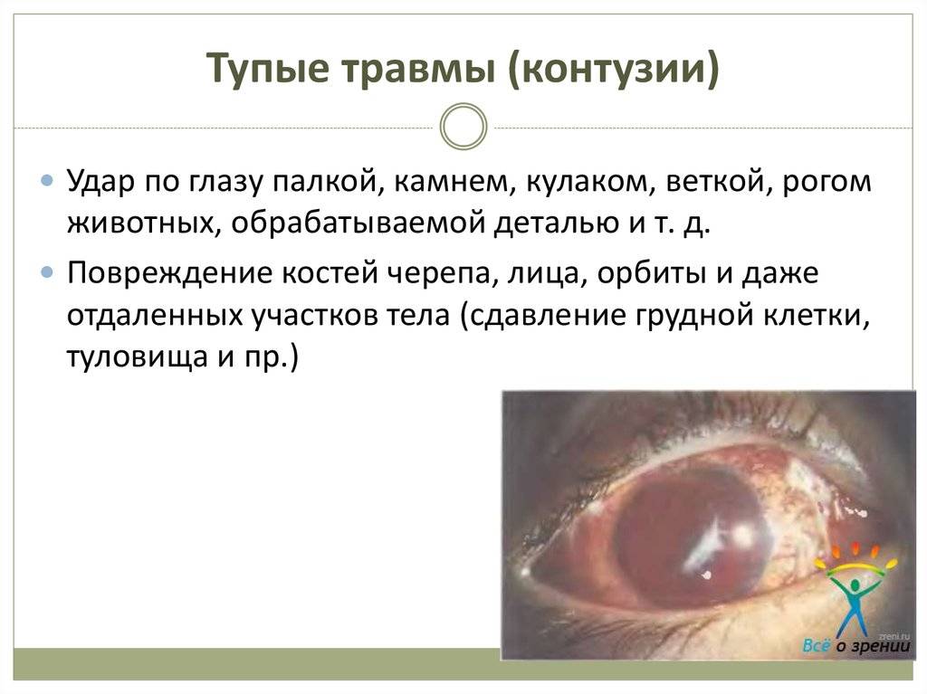 Контузии глаз, признаки, симптомы, лечение.