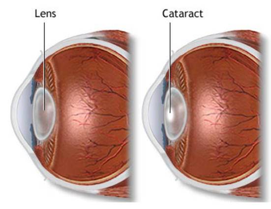 Что такое осложненная катаракта глаз: чем опасна и как ее лечить