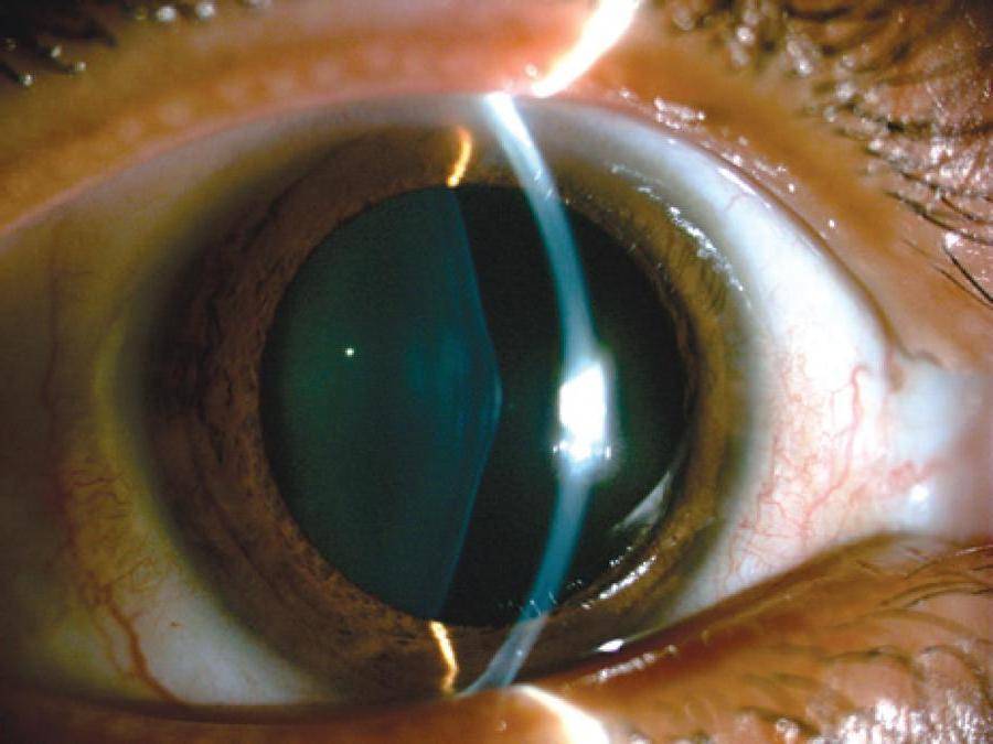 Что такое незрелая катаракта, нужна ли операция или стоит подождать