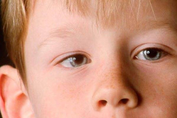 Заболевание глаз амблиопия у взрослых