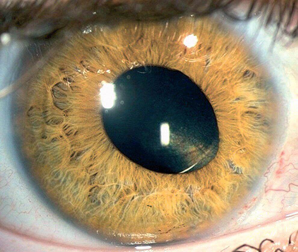 Помутнение хрусталика глаза - лечение, причины и симптомы
