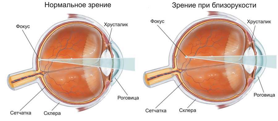 Можно ли восстановить зрение при близорукости?