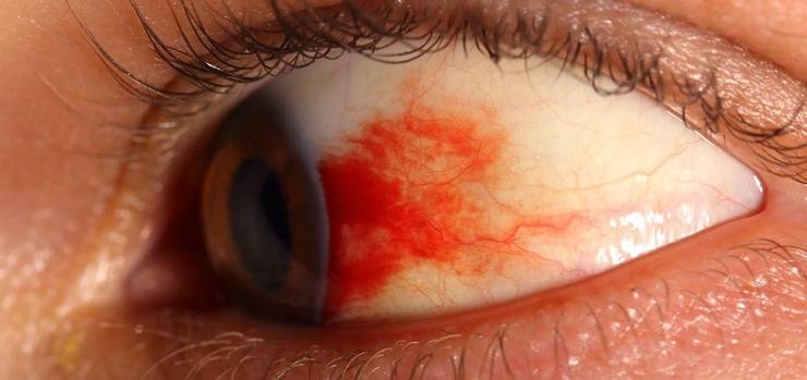 Ожог глаза: симптомы, лечение и первая помощь