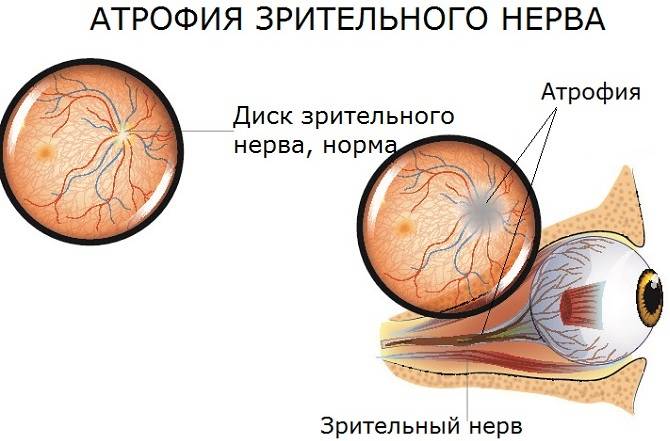 Атрофия зрительного нерва