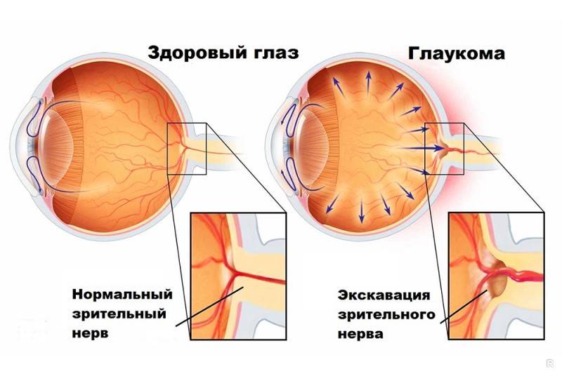 Закрытоугольная глаукома. причины, симптомы, диагностика, лечение и профилактика заболевания.