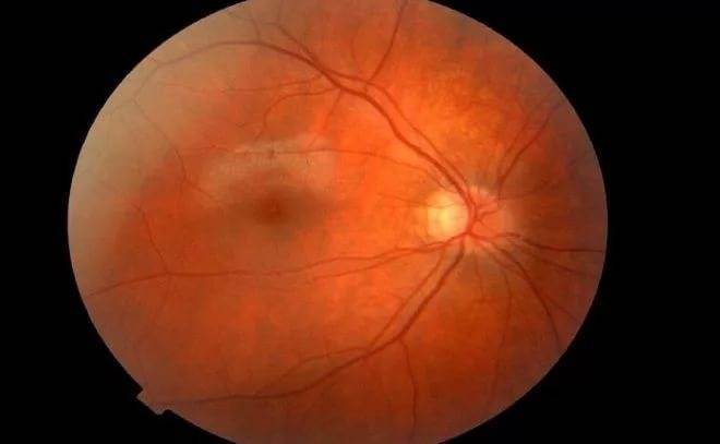 Дистрофия сетчатки глаза - причины, симптомы, лечение и профилактика