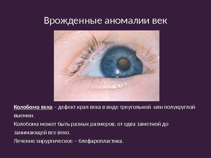 Что такое колобома радужки глаза? как лечить патологию?