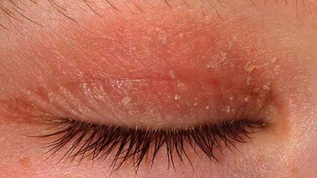 Сухая кожа под глазами и вокруг глаз: причины и лечение
