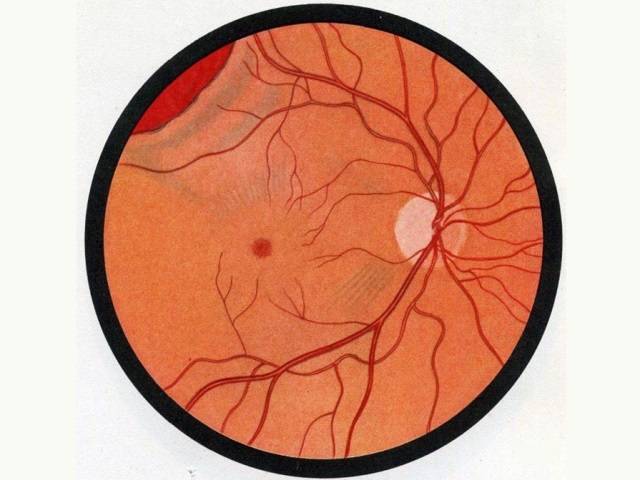 Фоновая ретинопатия: симптомы ретинальных сосудистых изменений