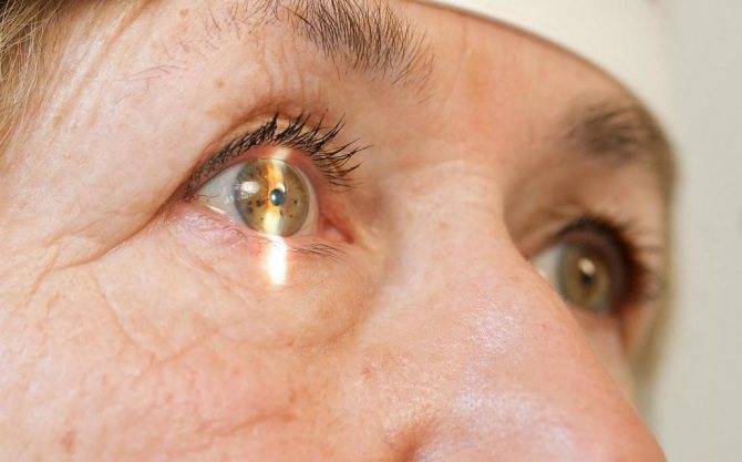 Можно ли вылечить глаукому без операции?