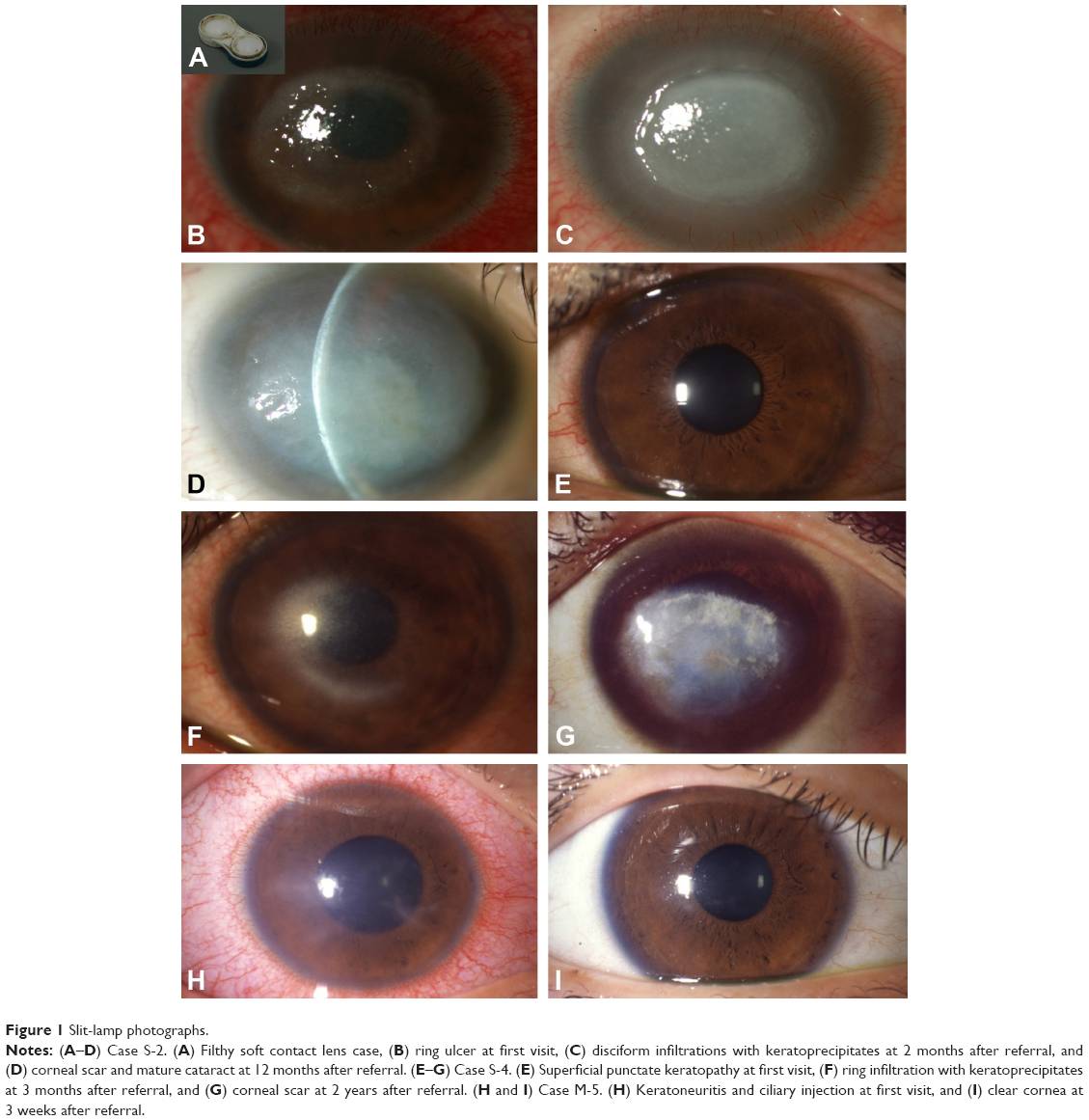 Симптомы и лечение нитчатого кератита глаза