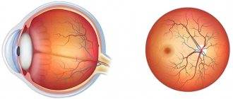 Отек диска зрительного нерва: симптомы, причины и лечение