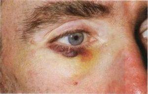 Появился синяк под глазом без удара: причины, гематома на верхнем веке, над, лечение