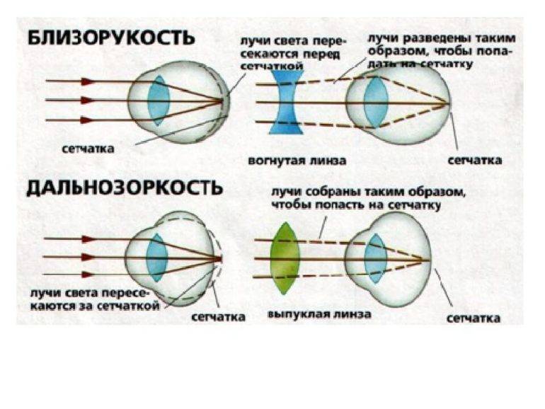 Близорукость - это минус или плюс зрения, очки с какими диоптриями нужно выбирать при миопии, а какие при дальнозоркости