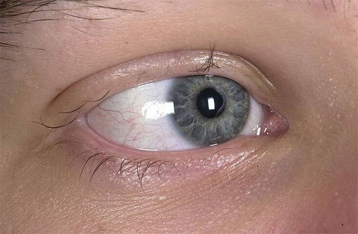 Отслоение сетчатки глаза: последствия после операции, что это такое и чем грозит