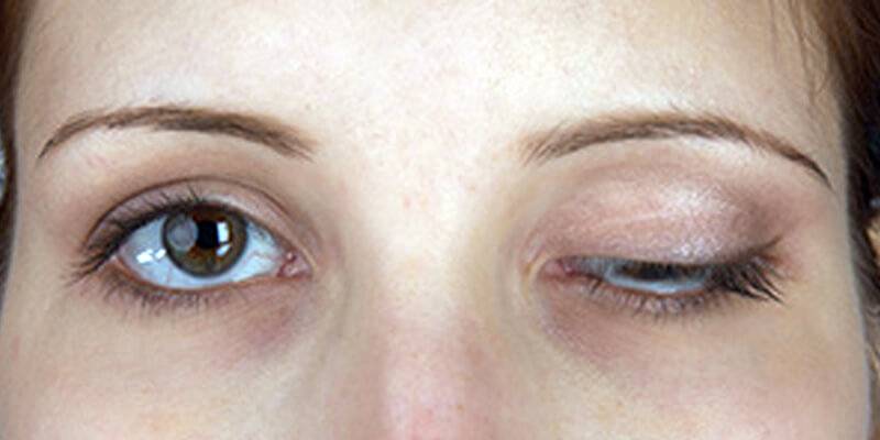 Веко глаза - заболевания и воспаления на верхнем, болячки нижнего, как называются: глазной ячмень
