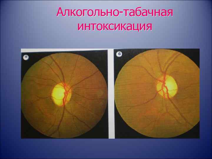 Амавроз лебера (пигментный ретинит): симптомы и лечение