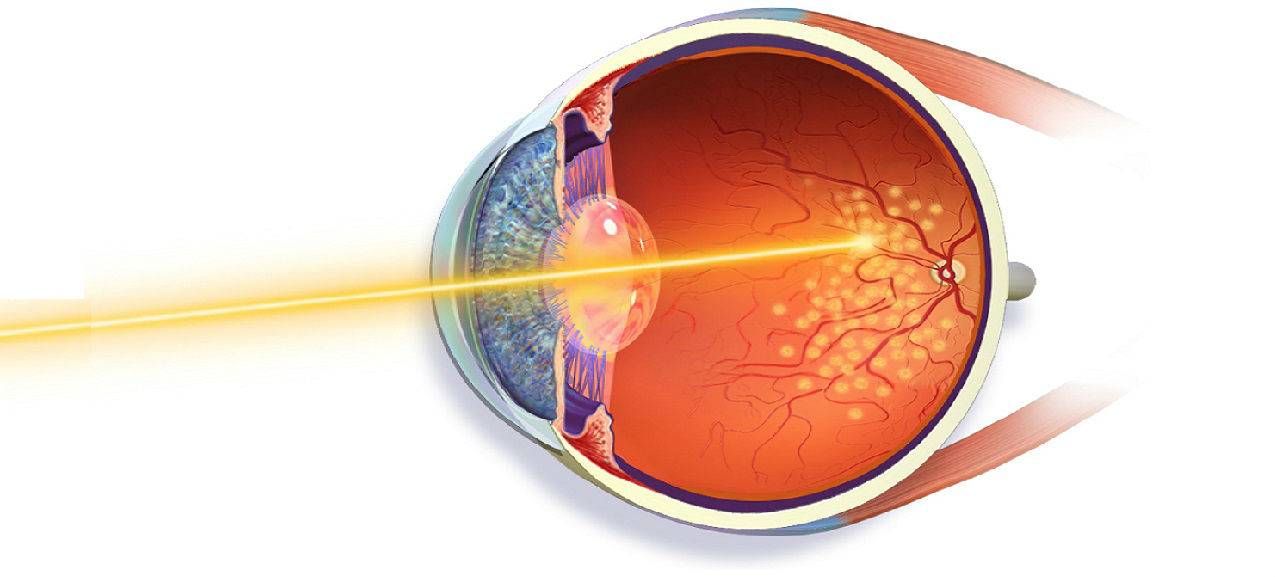 Лазерная коагуляция сетчатки глаза: возможности, операция, реабилитация