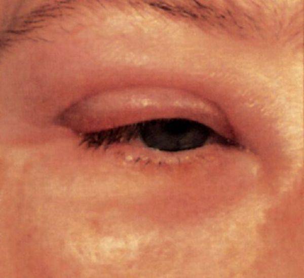 Веко опухло над глазом: причины, симптомы, народные и медикаментозные средства лечения