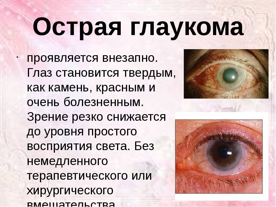 Глаукома: причины, симптомы, лечение и профилактика глаукомы у взрослых | медицинский портал spacehealth